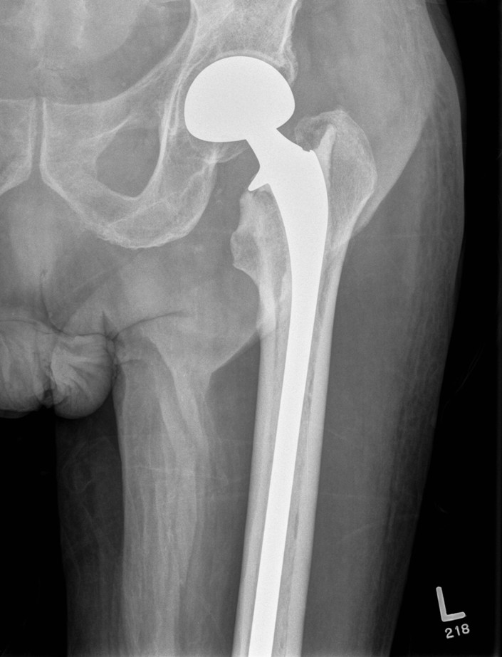 Intertrochanteric Met Prosthesis